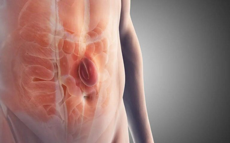 Abaulamento no abdômen que aparece ao fazer força: quando pode ser hérnia e precisa de cirurgia