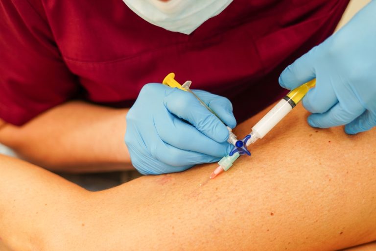 Escleroterapia: quando o tratamento das varizes vai além da estética